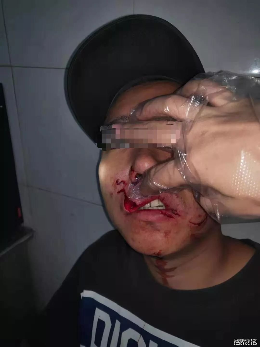 ���������ӳ��տ�������BTҳ��ҧ�沿��40�����ֳ�ͼ �������Ƿ��⳥��